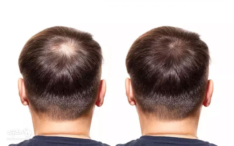 پیوند مو Hair Transplantation