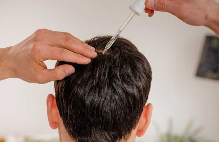 ماینوکسیدیل چیست؟