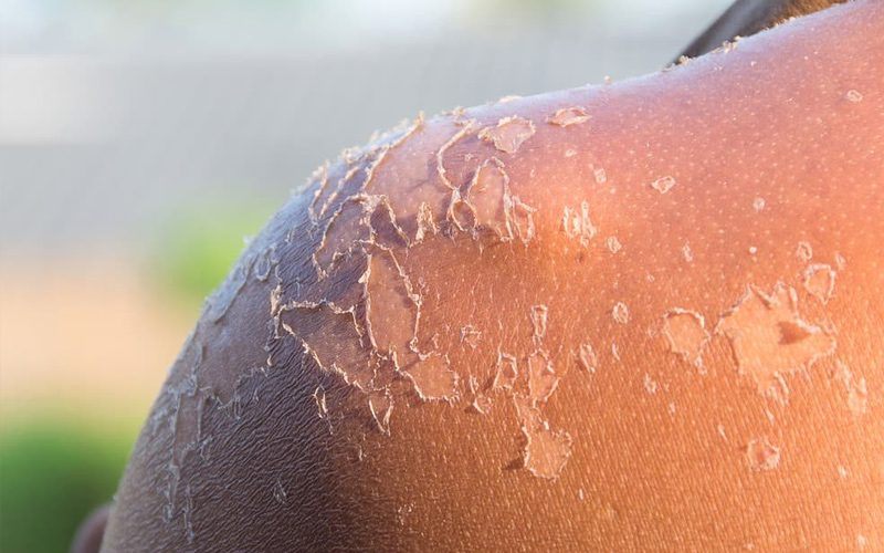آفتاب‌سوختگی، از مشکلات رایج بهاری