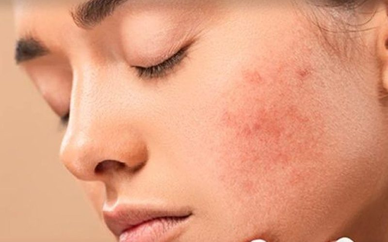 برای پوست چرب و مستعد آکنه