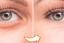 کاهش پف زیر چشم