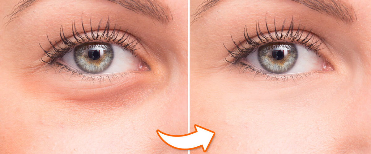 کاهش پف زیر چشم