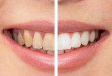 بهترین خمیر دندان سفید کننده