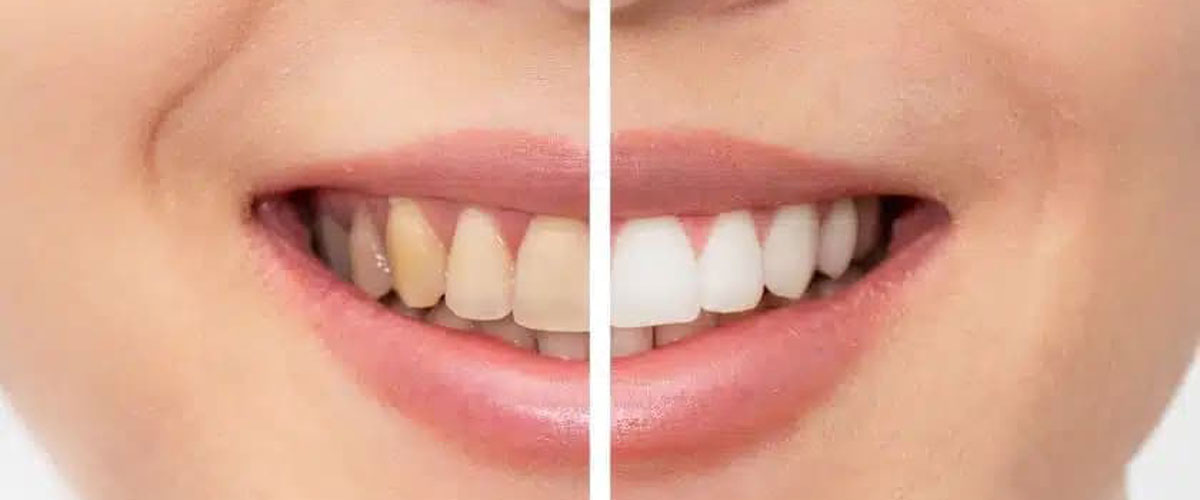 بهترین خمیر دندان سفید کننده